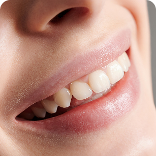 Tanden Bleken Tandartspraktijk SierSmile