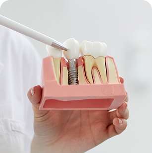 Implantalogie SierSmile