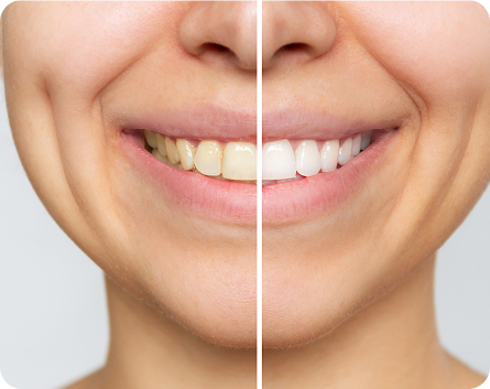 Tanden Bleken Voor en Na